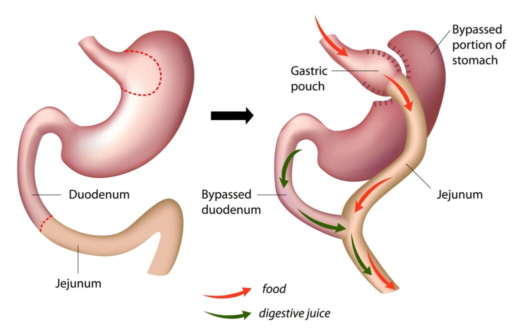 GASTRIC BYPASS SURGERY