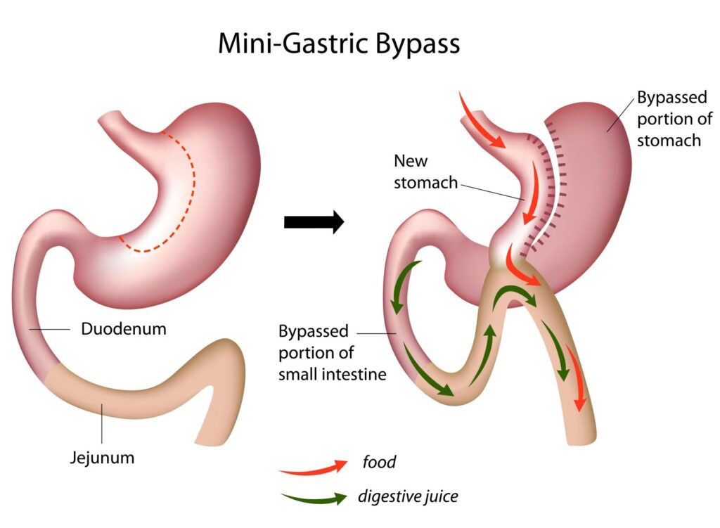 Gastric Bypass diagram